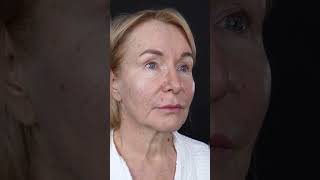 3 недели после круговой подтяжки лица и нижней блефаропластики👌 Результат 🔥