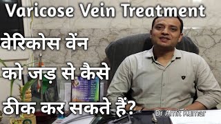 Varicose Veins Treatment |वेरिकोस वेंन को जड़ से कैसे ठीक कर सकते हैं?