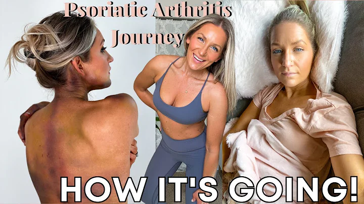 Psoriatic Arthritis Journey *UPDATE 2023* 10 YEARS SINCE DIAGNOSIS | psa treatment, biologics, diet