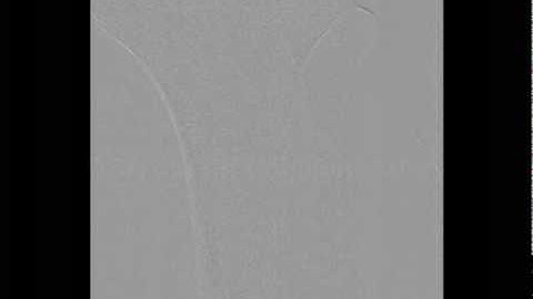 Percutaneous aspiration of popliteal artery thrombus