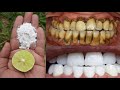 Magical Teeth Whitening Remedy, Get Whiten Your Teeth at Home in 2 Minutes