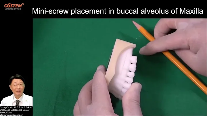 When and How to use ＂Orthodontic Screw＂ All Lectures Edition 1~12