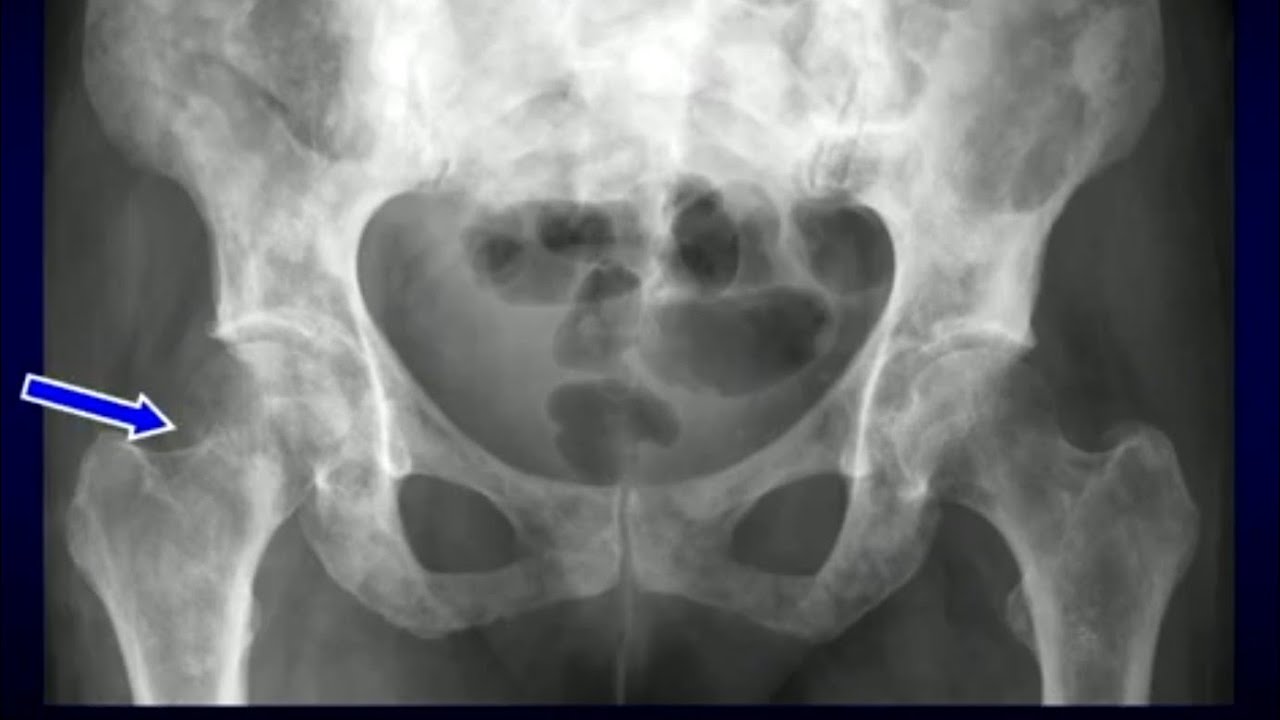 Radiographie du bassin interpretation - YouTube