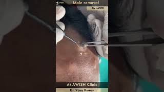 Mole on forehead Removal by RF Painless mole removing #mole #remove #moles #awishclinic #shorts