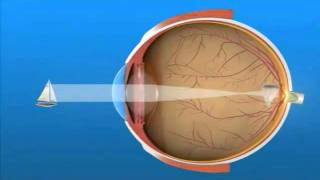 Myopia - Maryland Eye Doctor - Ophthalmologist Myopia - Maryland Eye Doctor - Ophthalmologist