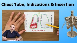 Chest Tube -Indications & how is the Insertion (part 1)