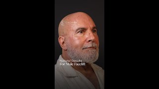 • Natural Results For Male Facelift #shorts
