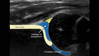 Congenital Hipdysplasia - Ultrasound Anatomy