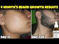 सिर्फ 4 महीने मे दाढ़ी आ गई कैसे ? Best minoxidil for beard growth | man matters minoxidil review |