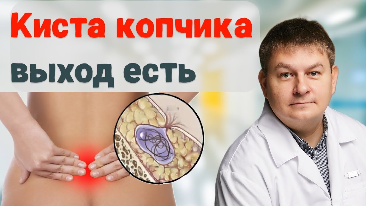 Киста копчика: симптомы, лечение и лазерное удаление