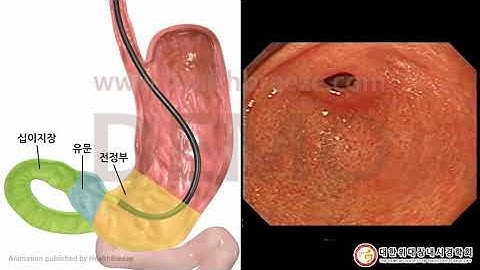 [시연용] b0010abko [대한위대장내시경학회][축약판]위내시경검사 안내