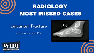 Most Missed Cases: Calcaneal Fracture