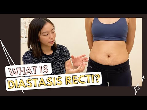 What is Diastasis