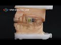 dorsal snoring device china dental lab