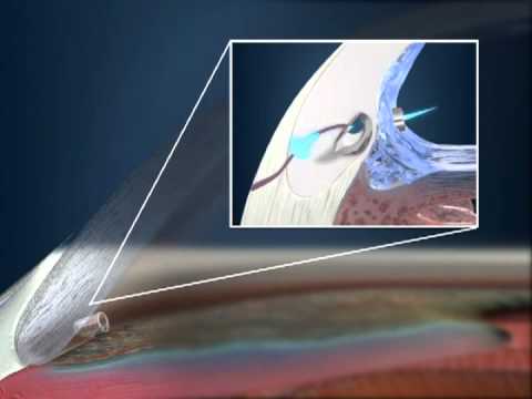 Vídeo: Implantación De Stent De Micro Bypass Trabecular De Segunda Generación: Análisis Retrospectivo Después De Un Seguimiento De 12 Y 24 Meses