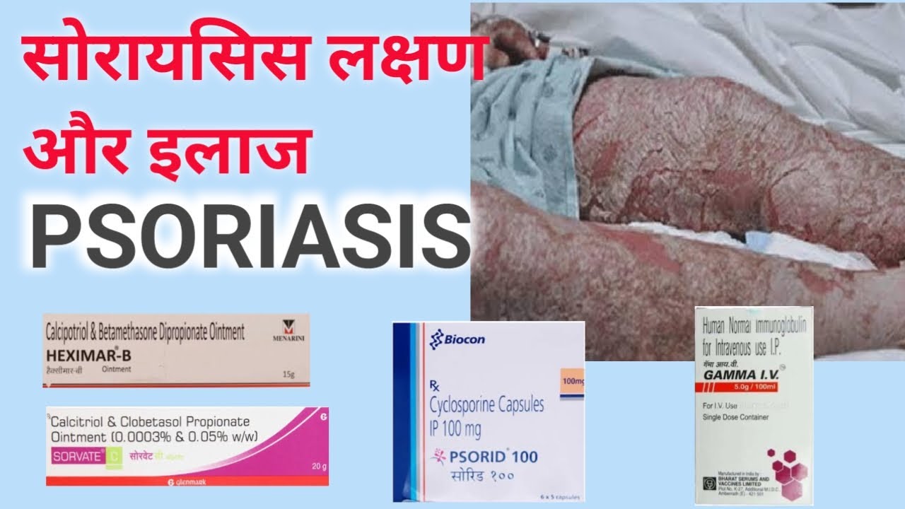 सोरायसिस के करण लक्षण और इलाज Psoriasis Causes, symptoms and