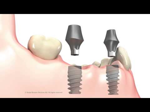 Video: Oluklu Taxta üçün Qovşaq Zolaqları: Yuxarı Və Aşağı, ölçüləri. Abutment Zolaqları Necə Quraşdırılır?