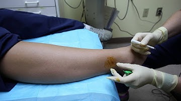 Epidermal Nerve Biopsy