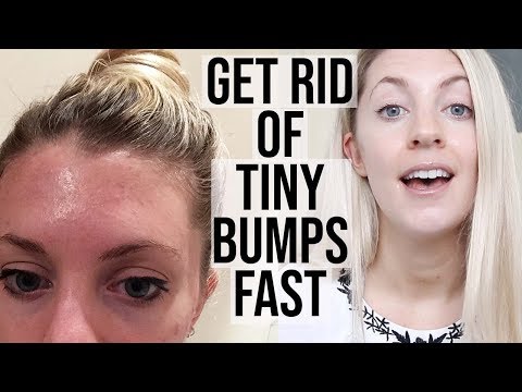 HOW TO GET RID OF TINY BUMPS ON YOUR FACE