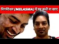 पिगमेंटेशन (PIGMENTATION/MELASMA) में यह FOOD कभी ना खाए ।