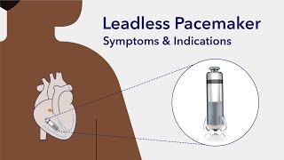 Transformative world of leadless pacemakers