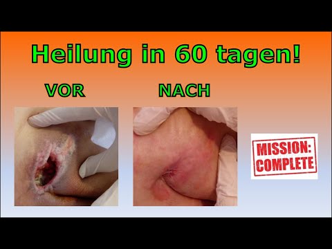 Video: Behandlung von Druckgeschwüren zu Hause