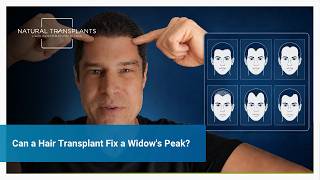 Can a Hair Transplant Fix a Widows Peak? | Dr. Huebner