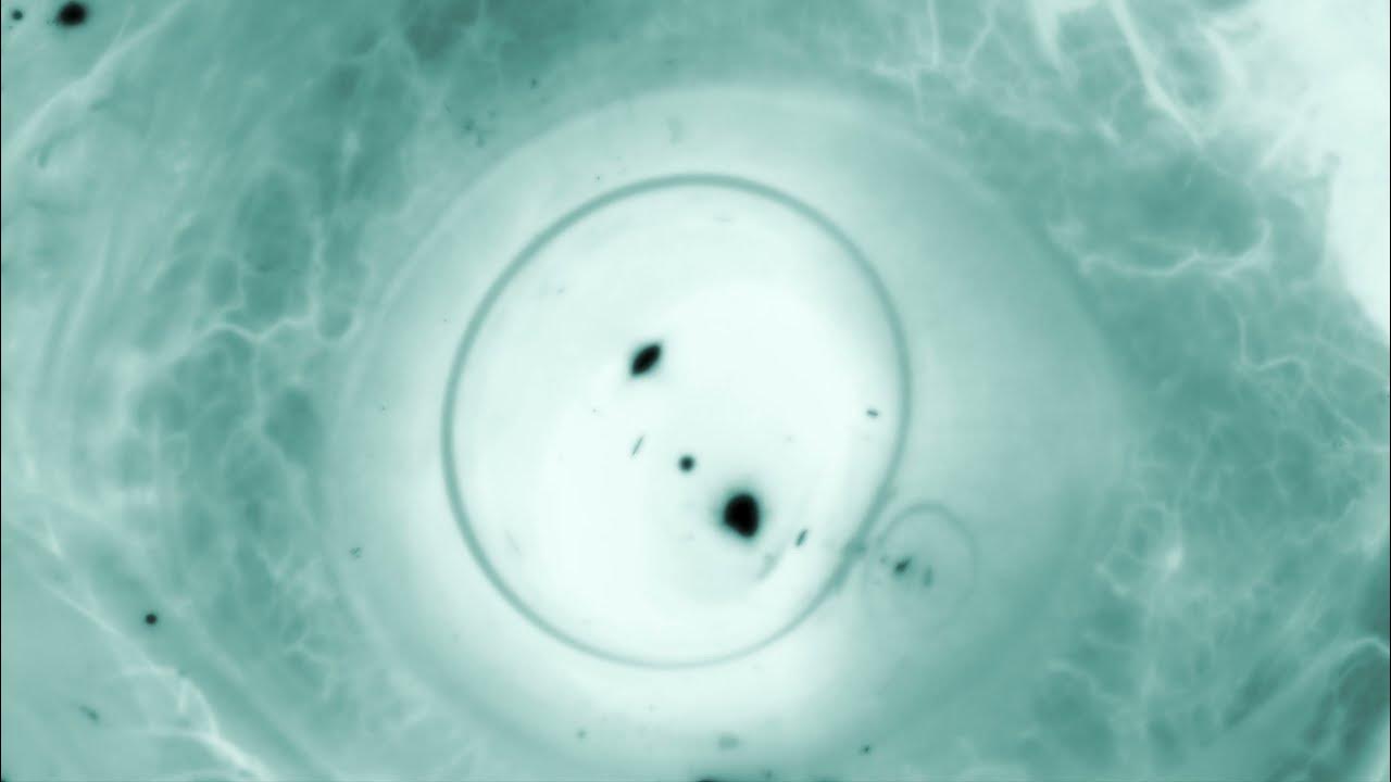 Capsular retraction syndrome with intraocular lens subluxation (RECHAZO