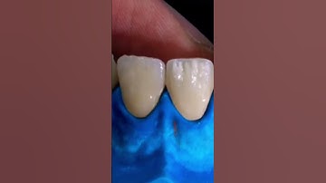 Emax Facial Cutback Layering On Zirconia