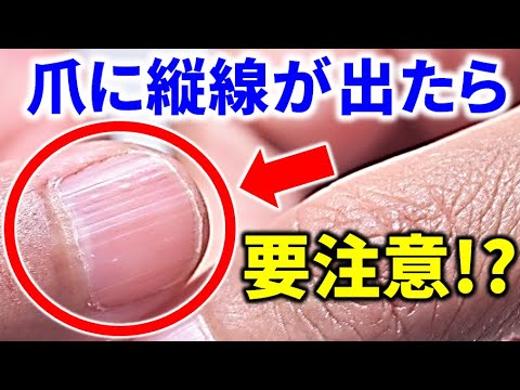 爪でわかる 爪に縦線が出たら要注意 爪でわかるあなたの健康 Youtube