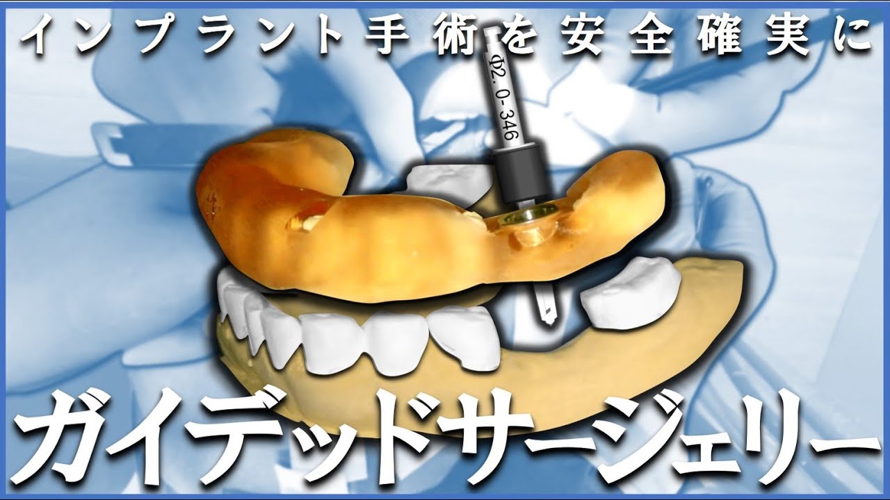 安全確実なる最新インプラント手術（ガイデッドサージェリーについて）