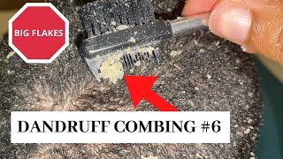 Dandruff combing #6 BIG FLAKES