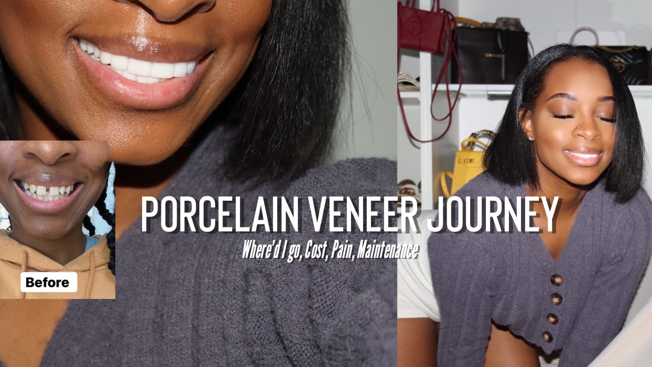 PORCELAIN VENEERS Q&A  | SMILE MAKEOVER | COSMETIC DENTISTRY | BEFORE AND AFTER | DETAILED VIDEO