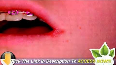 Is There an Angular Cheilitis Over the Counter Remedy That Works?