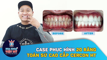 Tự Tin Cười Tươi Hơn Sau Khi Bọc 20 Răng Sứ Cercon HT - Doanh Nhân Khoa Vương
