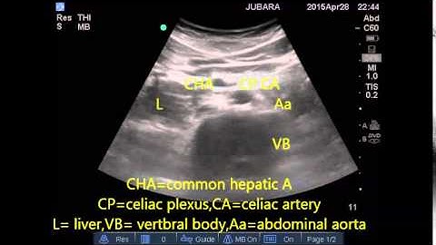 celiac plexus sonoanatomy
