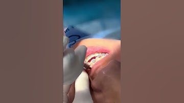 [Thực Tế] Niềng Răng Ở Nha Khoa Nụ Cười – Kết Quả Không Ngờ Sau 2 Năm!