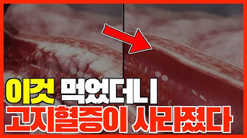 이것 먹으면 고지혈증이 사라진다. 고지혈증에좋은음식