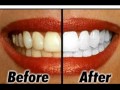 5 Cara Murah dan Mudah Memutihkan Gigi !