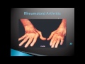 Dr. Chatwell: Could my swollen joints be Rheumatoid Arthritis?