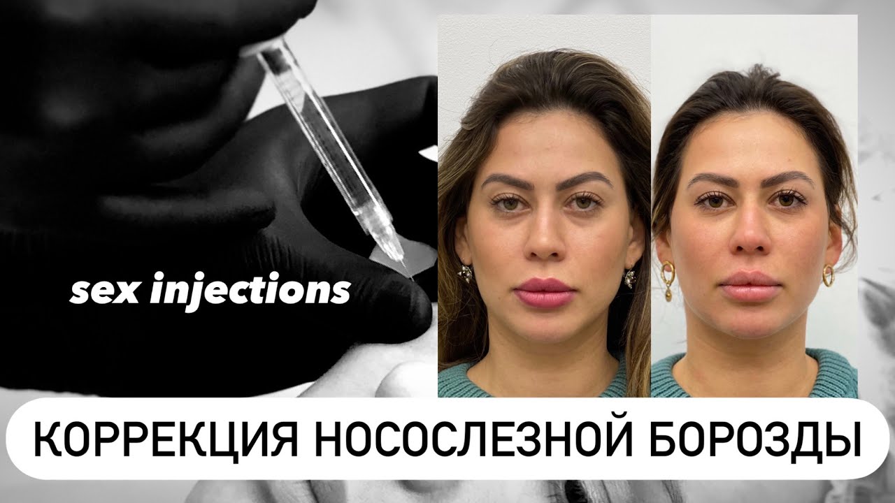 НОСОСЛЕЗНАЯ БОРОЗДА dr Sitanovich