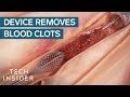 How this device safely removes blood clots  tech insider