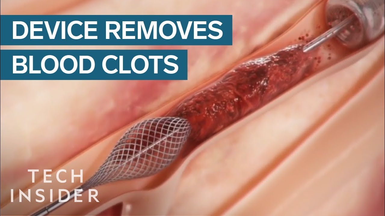 ⁣How This Device Safely Removes Blood Clots | Tech Insider