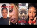 I WOKE UP WITH ACNE?| KAISERCOBY