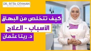   البهاق - أسبابه وعلاجه - كل ماتحتاج أن تعلم لعلاج صحيح