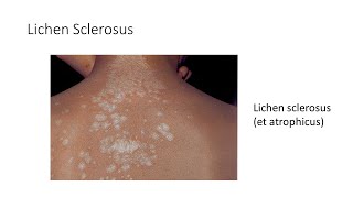 Lichen Sclerosus by House Job 9 views 1 month ago 4 minutes, 18 seconds