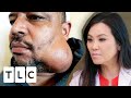 Man With Unusual Mass On His Jaw Has Been To 7 Different Doctors | Dr. Pimple Popper: Before The Pop