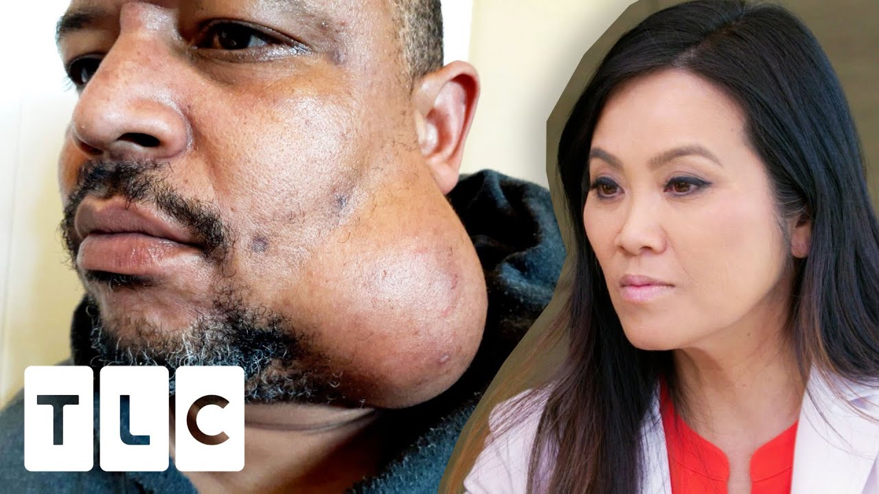 Man With Unusual Mass On His Jaw Has Been To 7 Different Doctors | Dr. Pimple Popper: Before The Pop