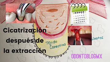 ¿Cuánto tiempo duelen las encías después de una extracción dental?