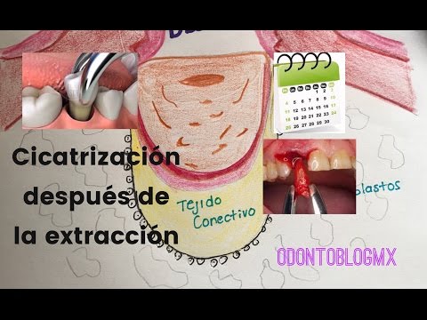 Video: Cómo curar las encías después de una extracción dental (con imágenes)